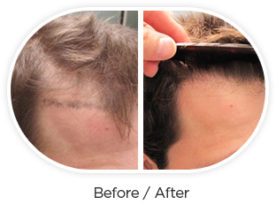 hair transplant dubai