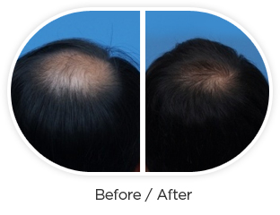 dubai hair loss