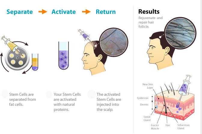 Platelet Rich Plasma PRP Skin Rejuvenation - Vampire Facelift - Facial skin rejuvenation PRP – Platelet Rich Plasma Therapy for Skin / Facial Rejuvenation.